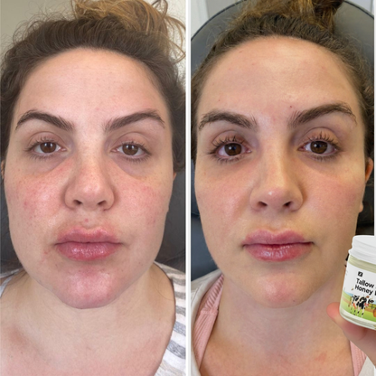 From flare-ups to calm skin, moisturizing, healing, protecting Tallow & Honey Balm