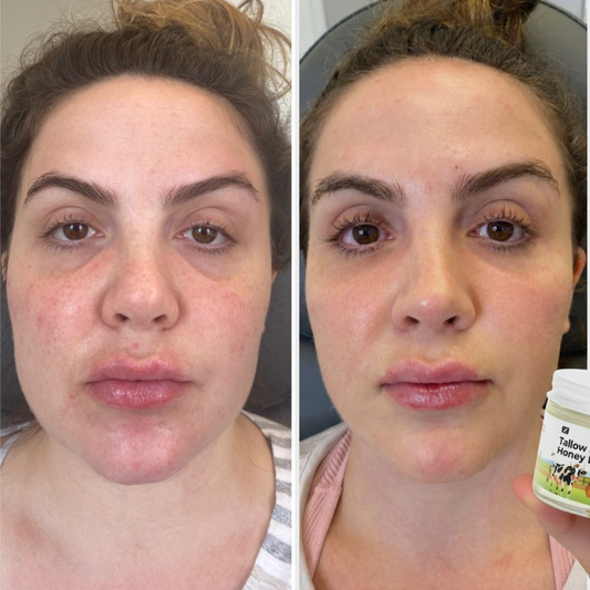 From flare-ups to calm skin, moisturizing, healing, protecting Tallow & Honey Balm