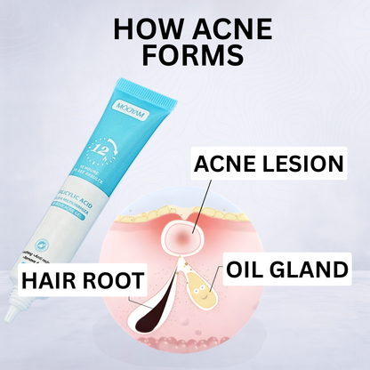 From flare-ups to flawless, visibly clearer skin with every use of Acne Gel