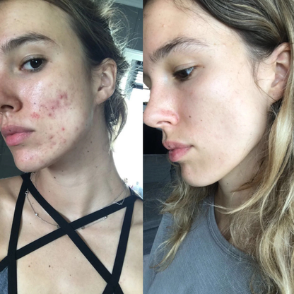 From flare-ups to flawless, visibly clearer skin with every use of Acne Gel