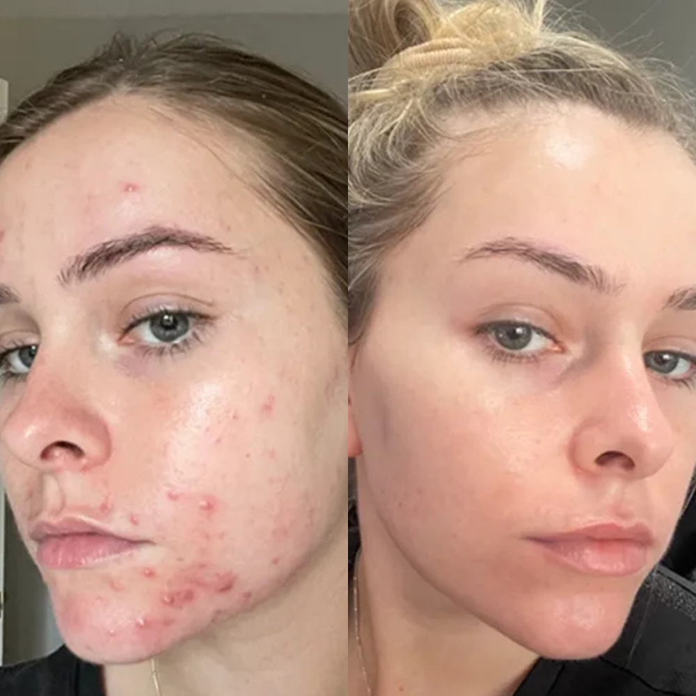 From flare-ups to flawless, visibly clearer skin with every use of Acne Gel