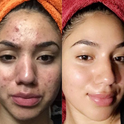 From flare-ups to flawless, visibly clearer skin with every use of Acne Gel