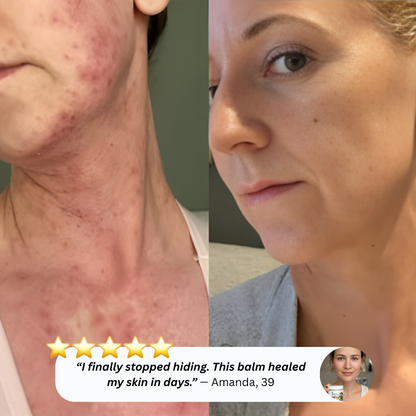 From flare-ups to calm skin, moisturizing, healing, protecting Tallow & Honey Balm